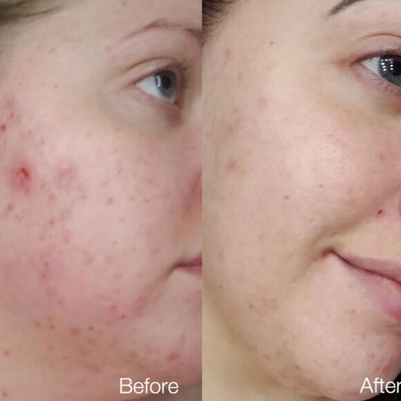 Aprilskin SET SkincareCarrotene Clarifying Serum, Foam Cleanser & Calendula Mask - Picture 2 of 12